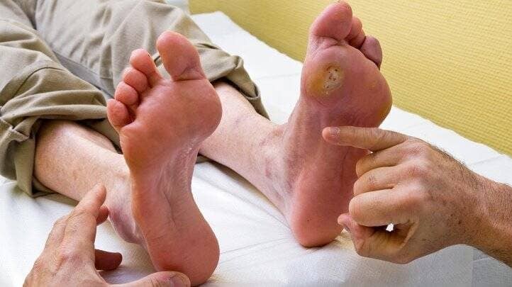 How To Spot A Diabetic Foot Ulcer?